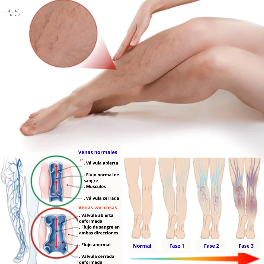 VEINS - Pack Tratamiento Várices
